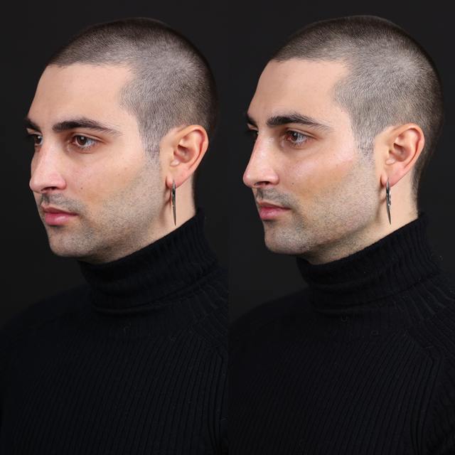 Unretouched before and after result, the drBand Clinic
