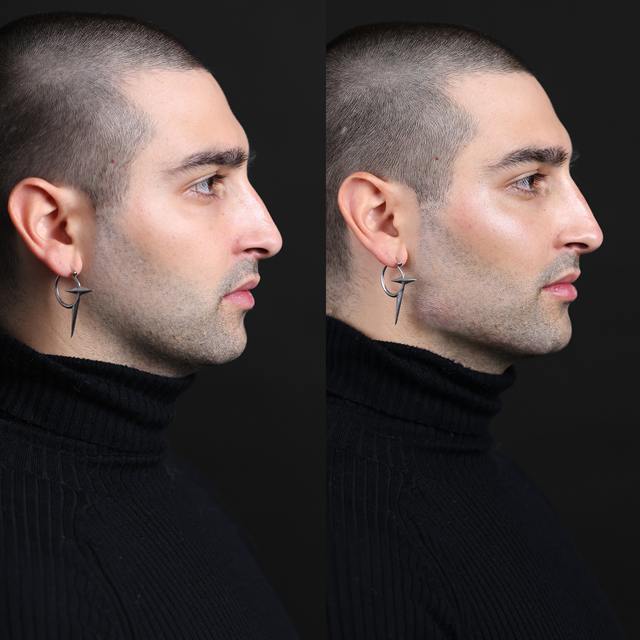 Unretouched before and after result, the drBand Clinic