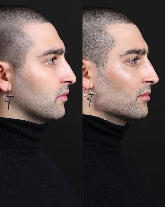 Unretouched before and after result, the drBand Clinic