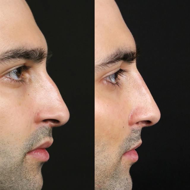 Unretouched before and after result, the drBand Clinic