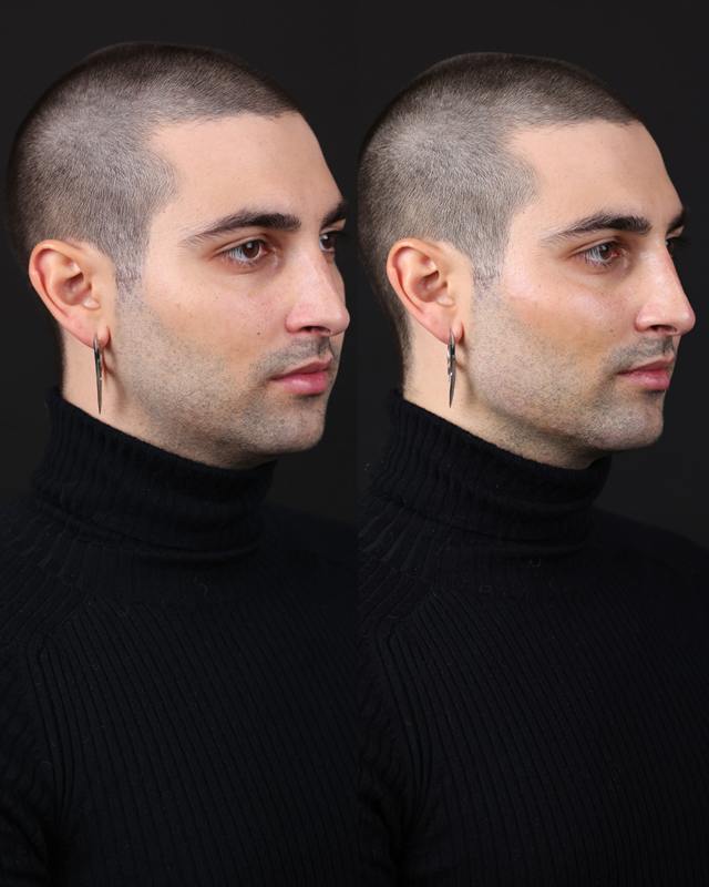 Unretouched before and after result, the drBand Clinic