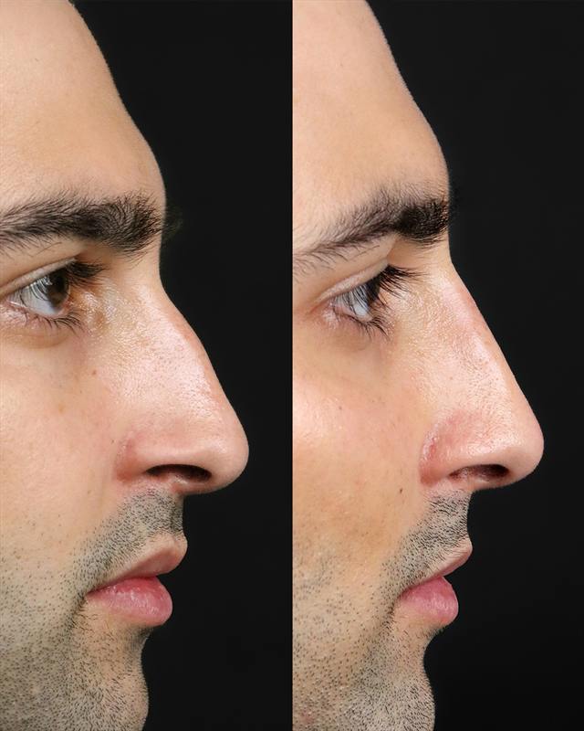 Unretouched before and after result, the drBand Clinic