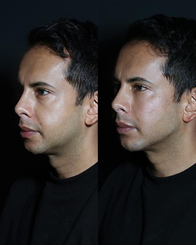Unretouched before and after result, the drBand Clinic