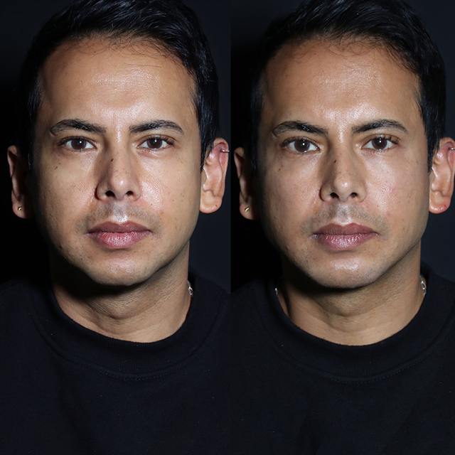 Unretouched before and after result, the drBand Clinic