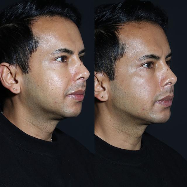 Unretouched before and after result, the drBand Clinic