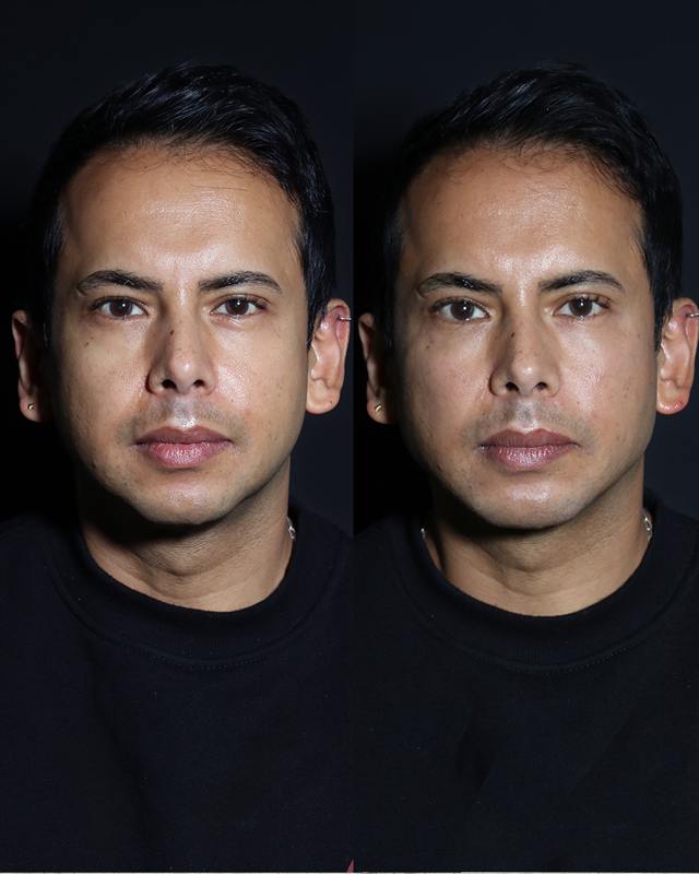 Unretouched before and after result, the drBand Clinic