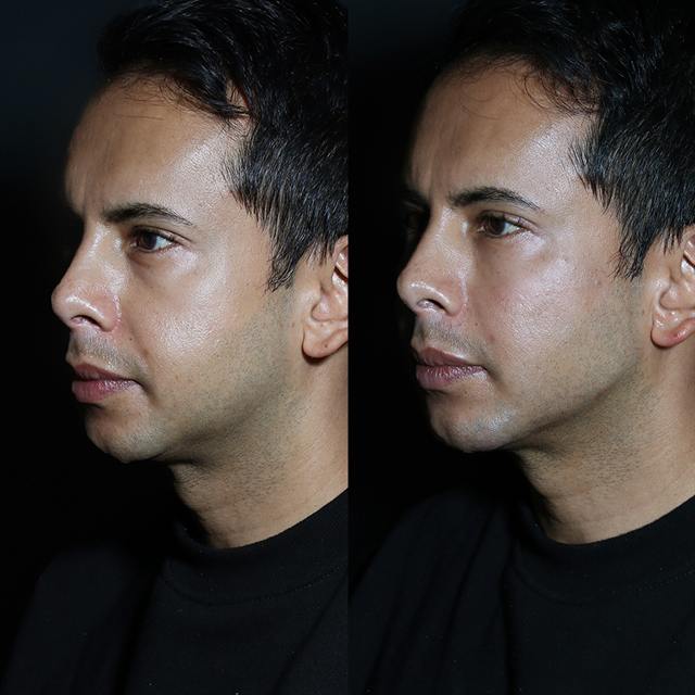 Unretouched before and after result, the drBand Clinic