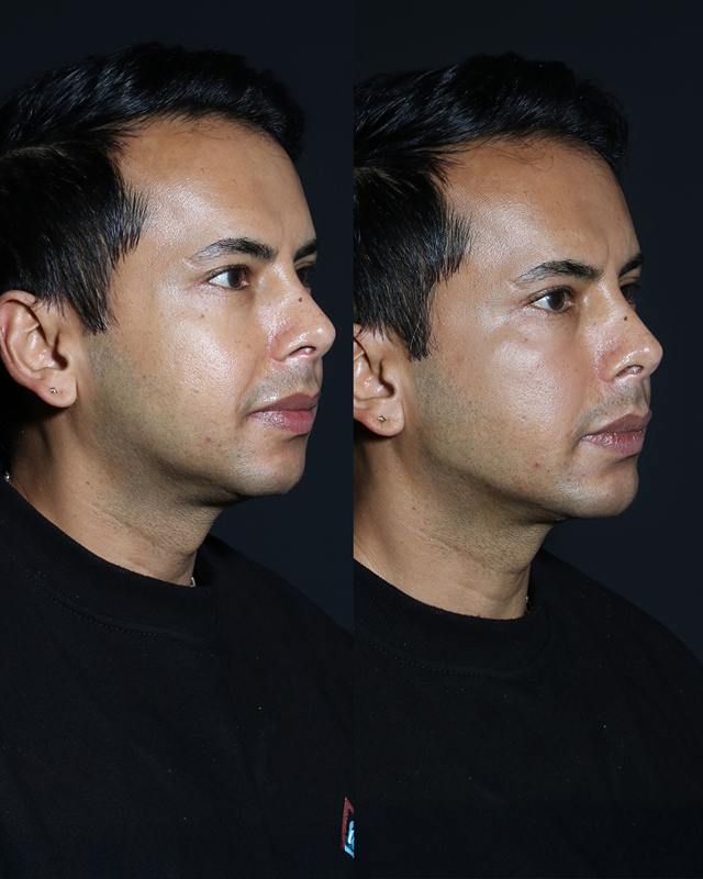 Unretouched before and after result, the drBand Clinic