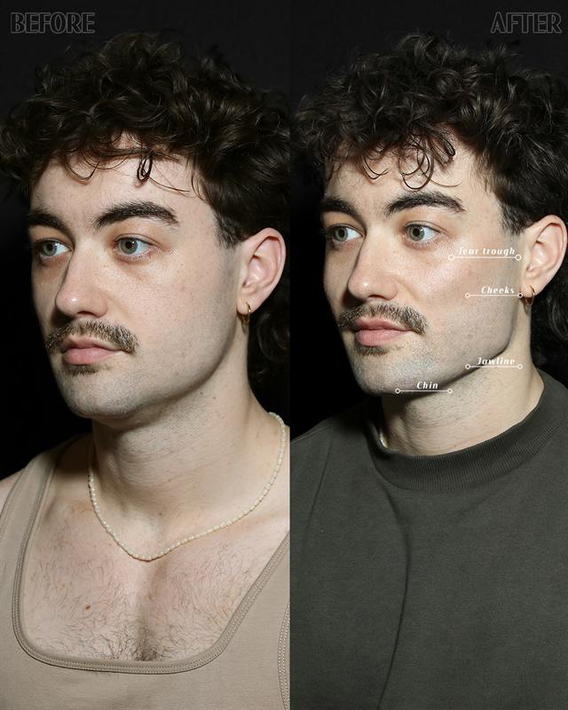 Unretouched before and after result, the drBand Clinic