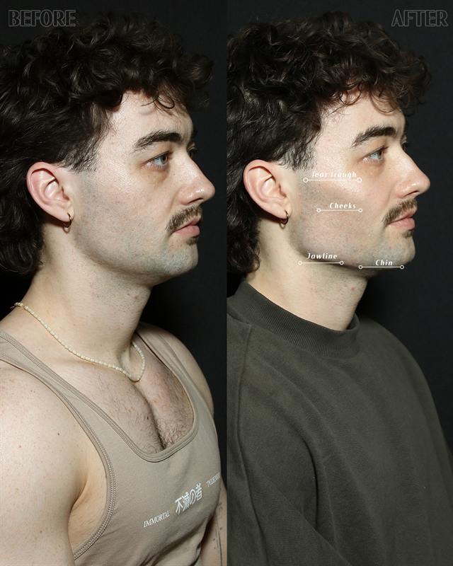 Unretouched before and after result, the drBand Clinic