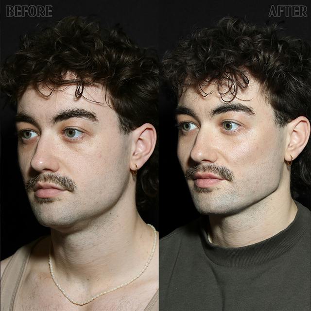 Unretouched before and after result, the drBand Clinic
