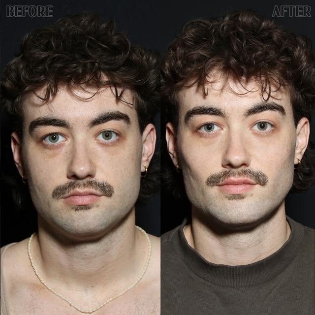 Unretouched before and after result, the drBand Clinic