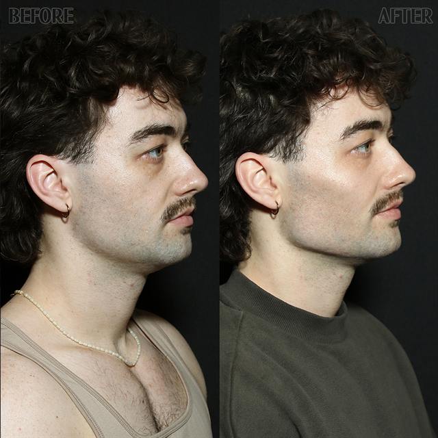 Unretouched before and after result, the drBand Clinic
