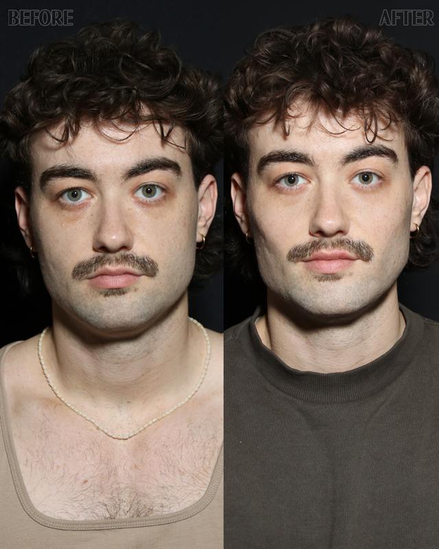 Unretouched before and after result, the drBand Clinic