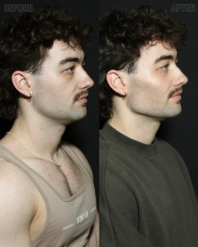 Unretouched before and after result, the drBand Clinic