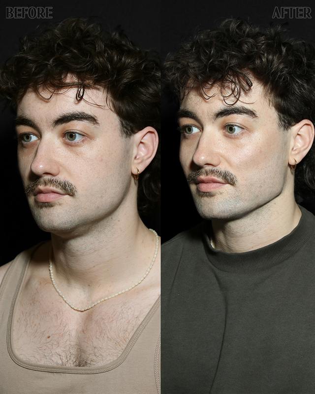 Unretouched before and after result, the drBand Clinic