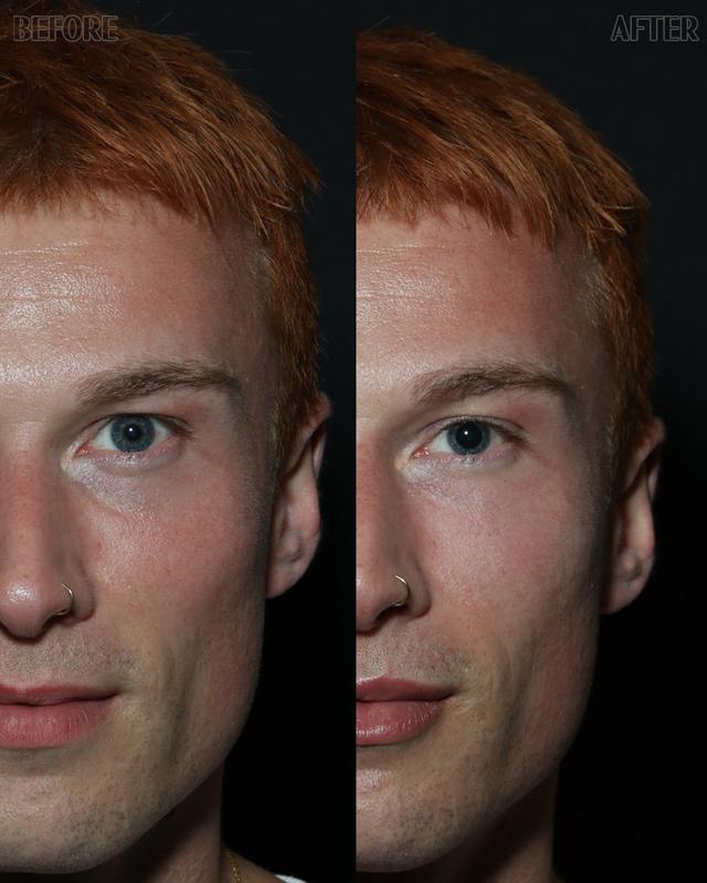 Unretouched before and after result, the drBand Clinic