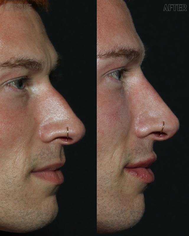 Unretouched before and after result, the drBand Clinic