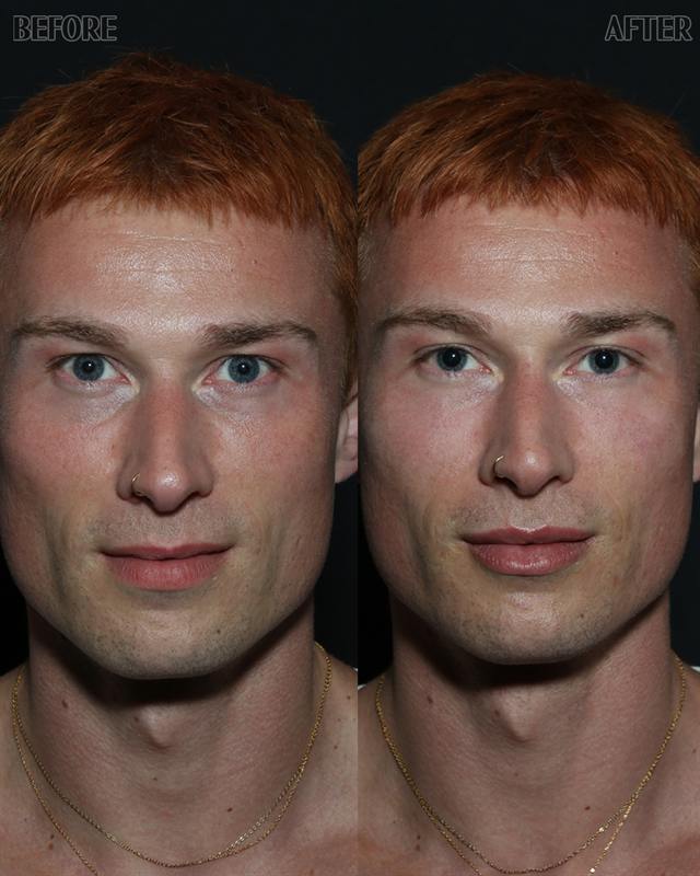 Unretouched before and after result, the drBand Clinic