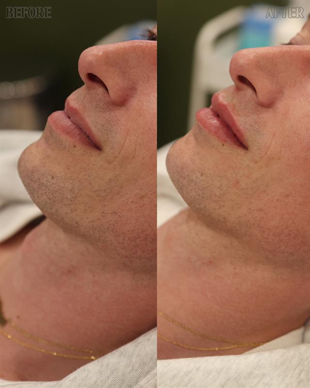 Unretouched before and after result, the drBand Clinic