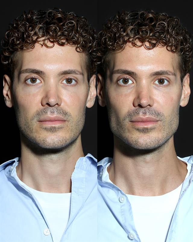 Unretouched before and after result, the drBand Clinic