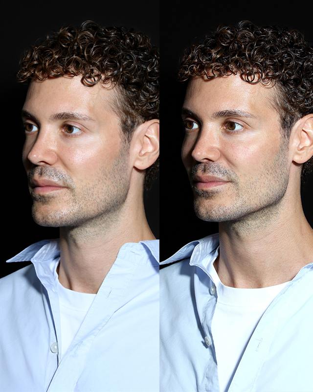 Unretouched before and after result, the drBand Clinic