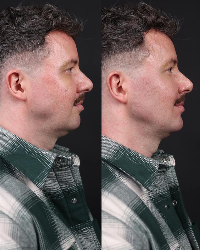 Unretouched before and after result, the drBand Clinic
