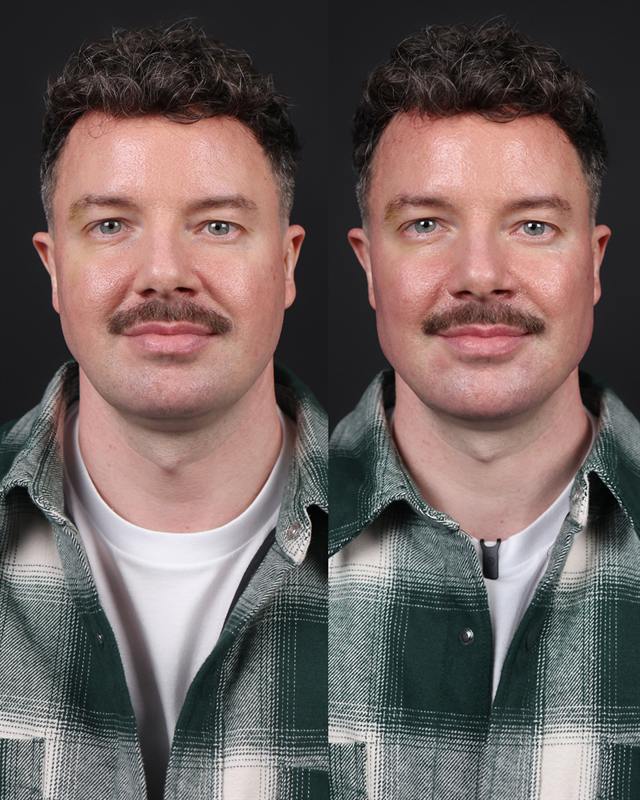 Unretouched before and after result, the drBand Clinic