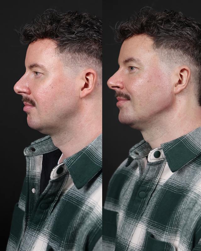 Unretouched before and after result, the drBand Clinic
