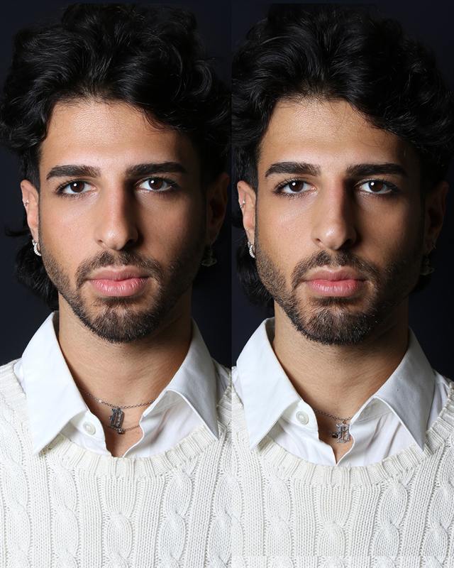 Unretouched before and after result, the drBand Clinic