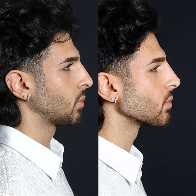 Unretouched before and after result, the drBand Clinic