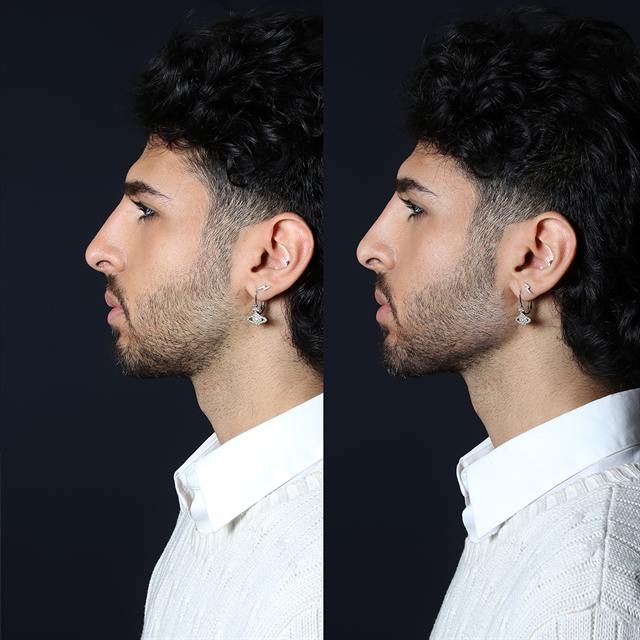 Unretouched before and after result, the drBand Clinic