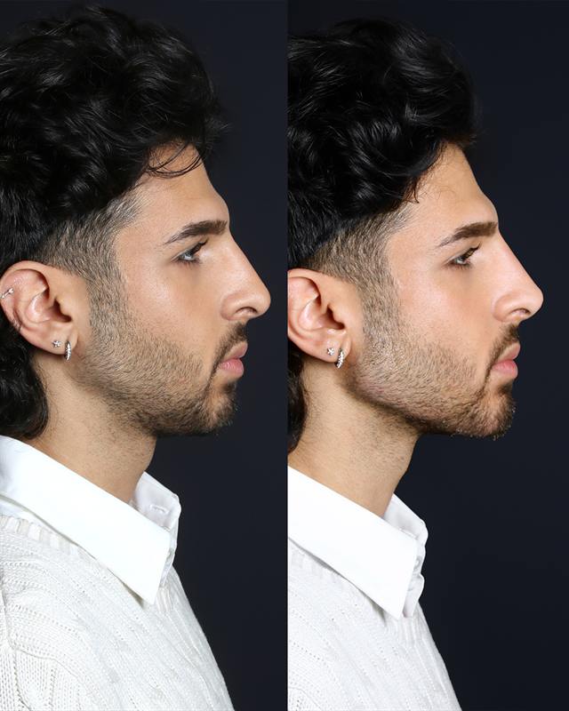 Unretouched before and after result, the drBand Clinic