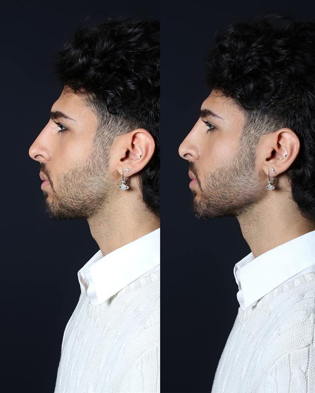 Unretouched before and after result, the drBand Clinic