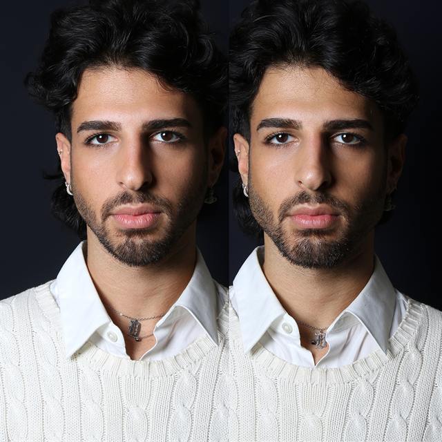 Unretouched before and after result, the drBand Clinic