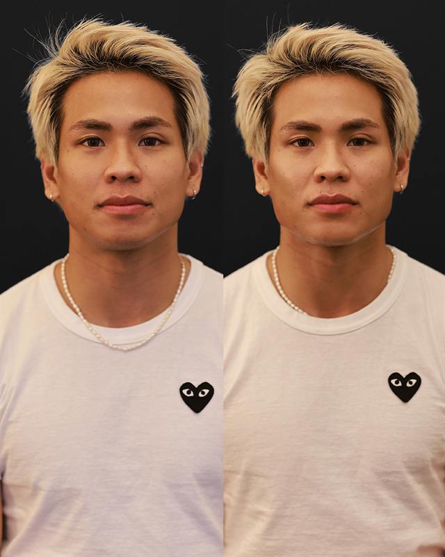 Unretouched before and after result, the drBand Clinic