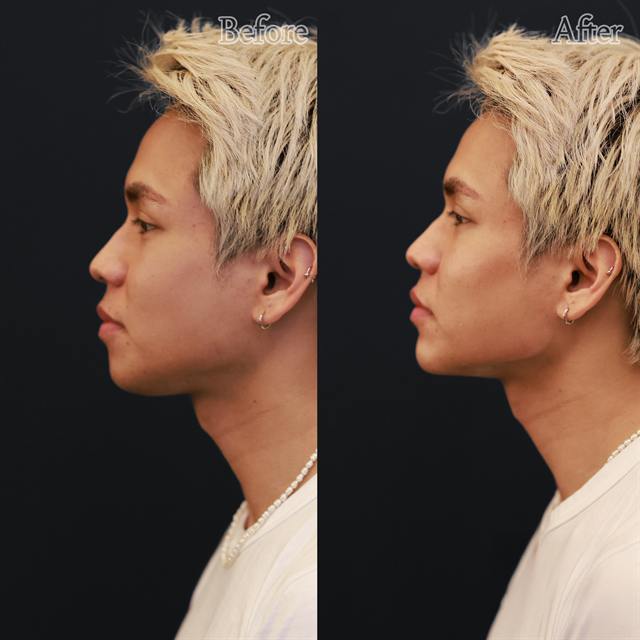 Unretouched before and after result, the drBand Clinic