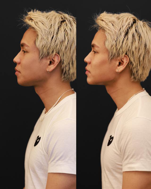 Unretouched before and after result, the drBand Clinic