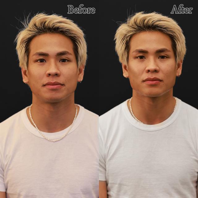 Unretouched before and after result, the drBand Clinic