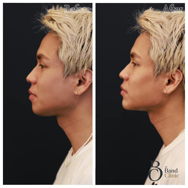 Unretouched before and after result, the drBand Clinic