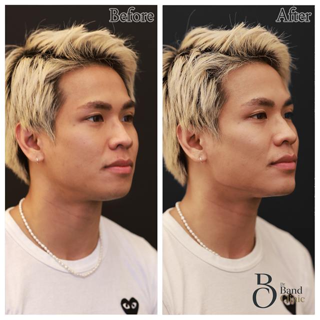 Unretouched before and after result, the drBand Clinic