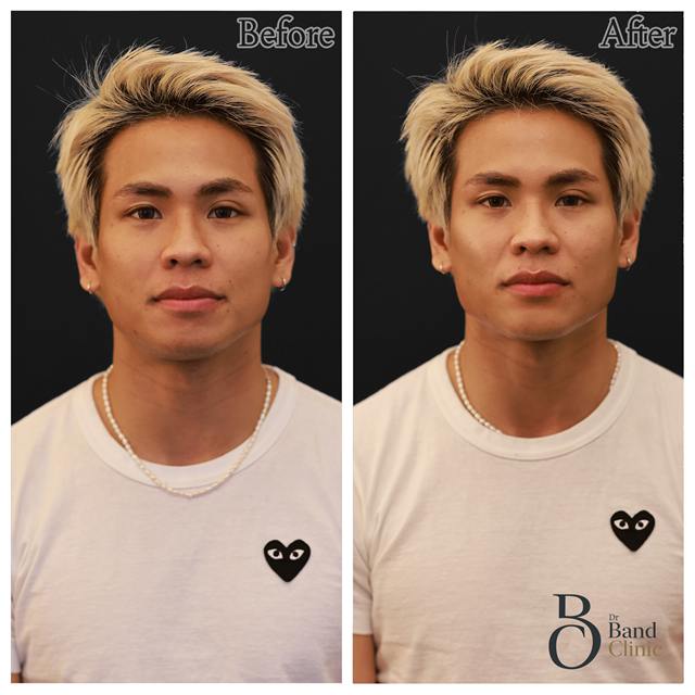 Unretouched before and after result, the drBand Clinic