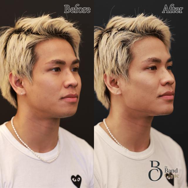 Unretouched before and after result, the drBand Clinic