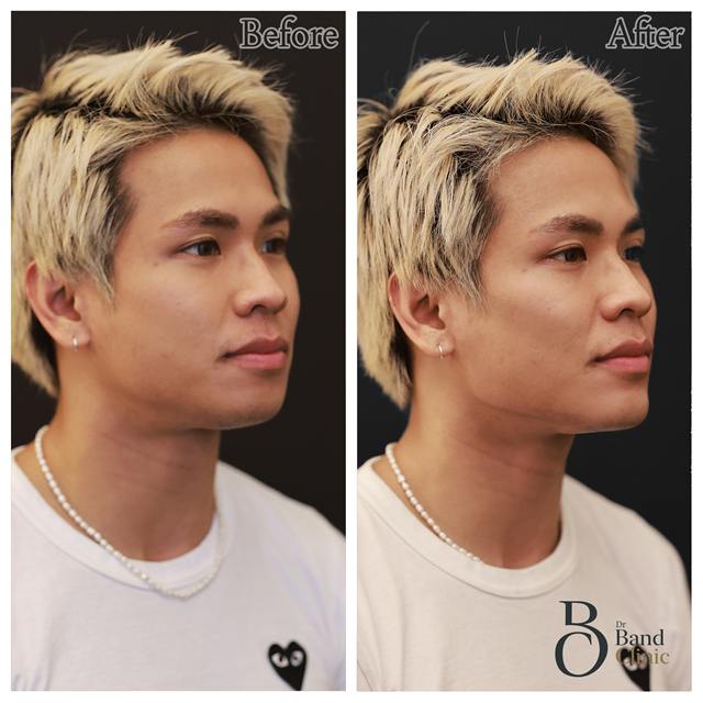 Unretouched before and after result, the drBand Clinic