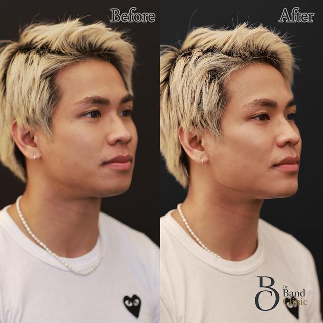 Unretouched before and after result, the drBand Clinic