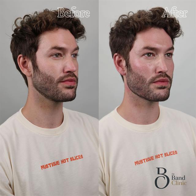 Unretouched before and after result, the drBand Clinic