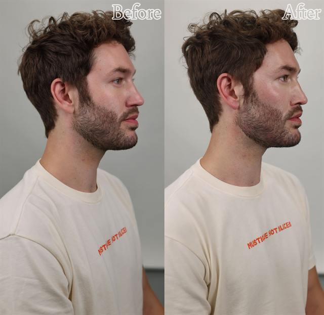 Unretouched before and after result, the drBand Clinic