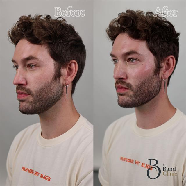 Unretouched before and after result, the drBand Clinic