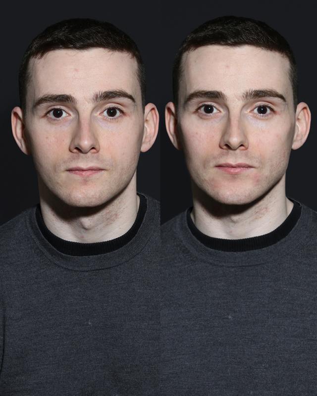 Unretouched before and after result, the drBand Clinic