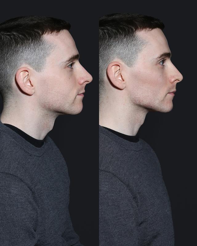 Unretouched before and after result, the drBand Clinic